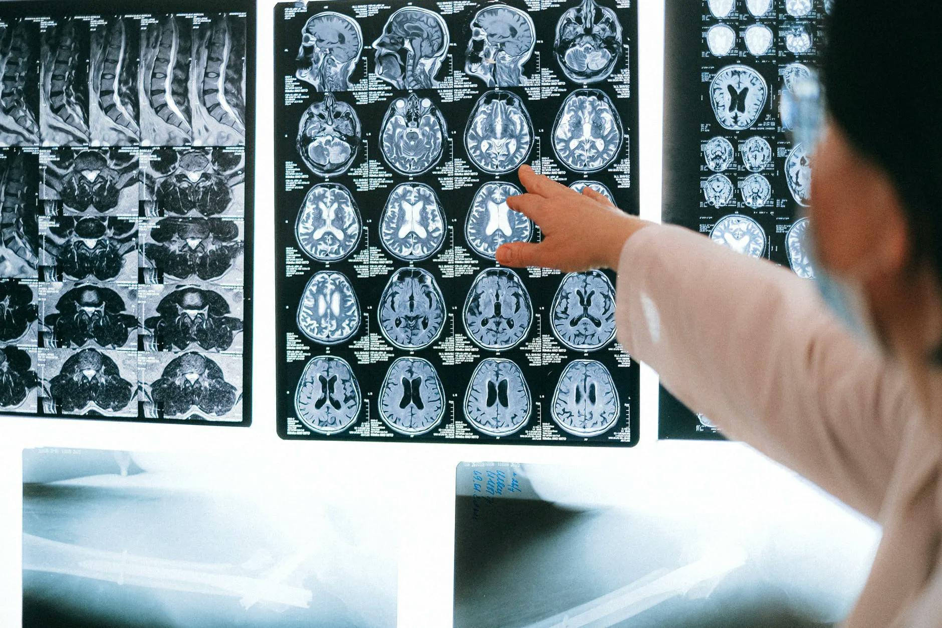 Eine Person zeigt mit den Händen auf Röntgenbilder eines Gehirns